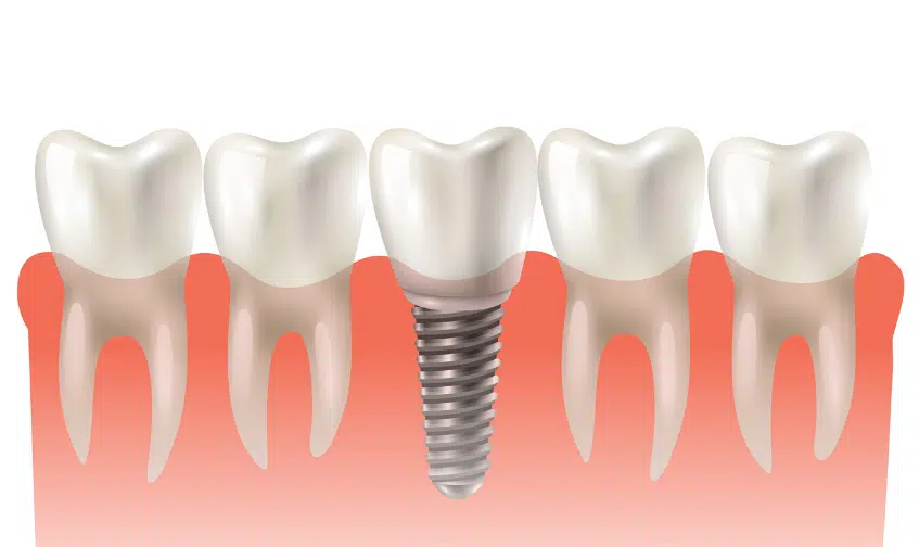Why Dental Implants Are the Best Solution for Replacing Missing Teeth 
