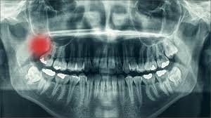How North York Dentists Prepare You for Wisdom Tooth Removal